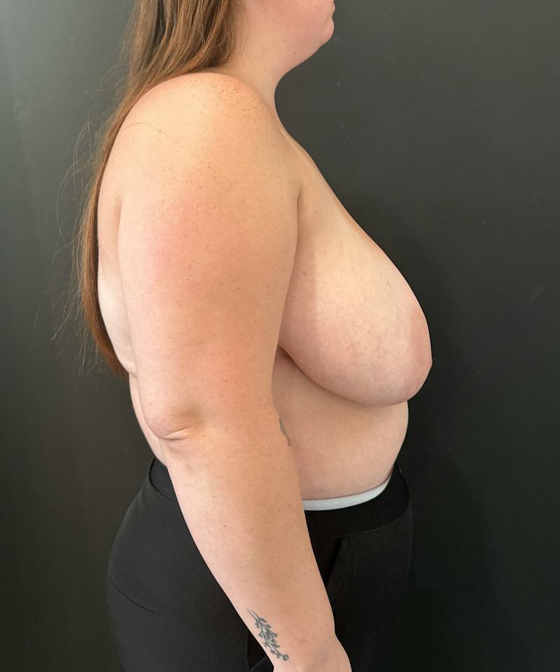 Breast Asymmetry Before & After Gallery - Patient 144861 - Image 5