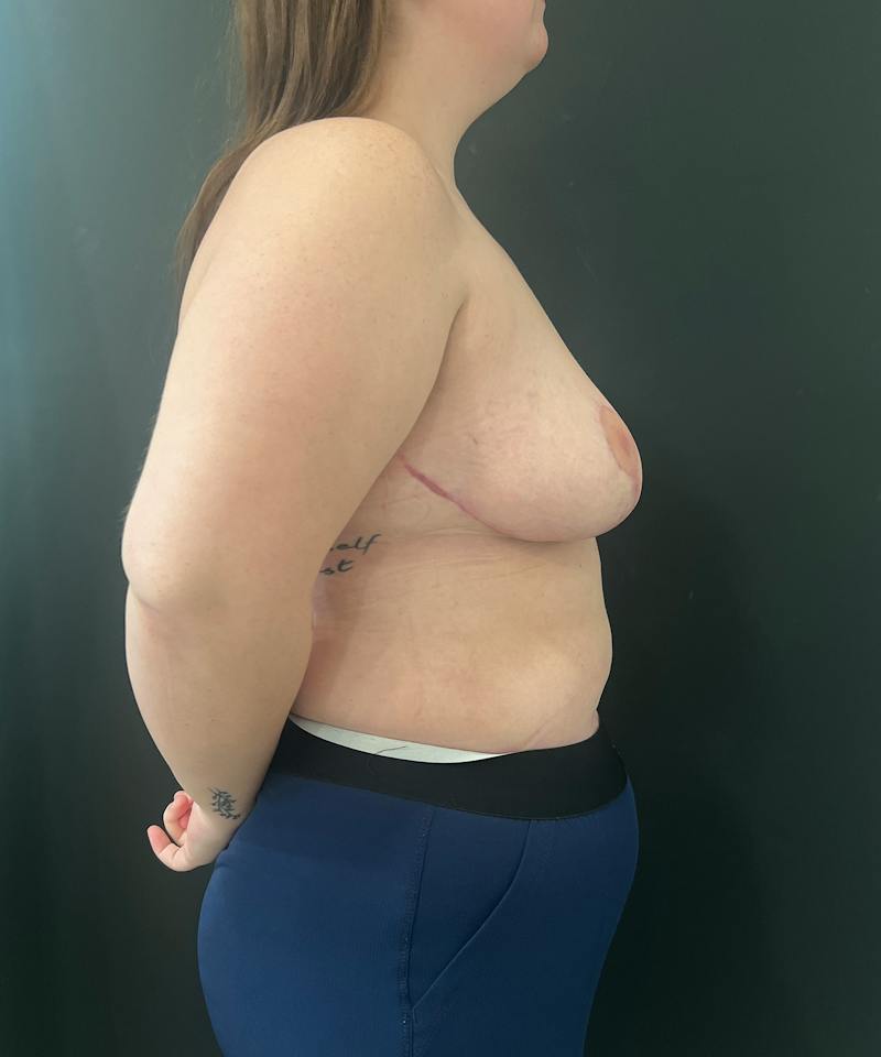 Breast Asymmetry Before & After Gallery - Patient 144861 - Image 6