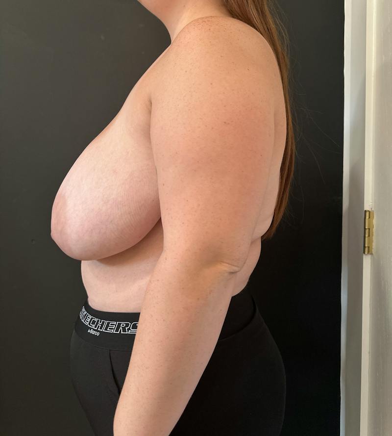 Breast Asymmetry Before & After Gallery - Patient 144861 - Image 9