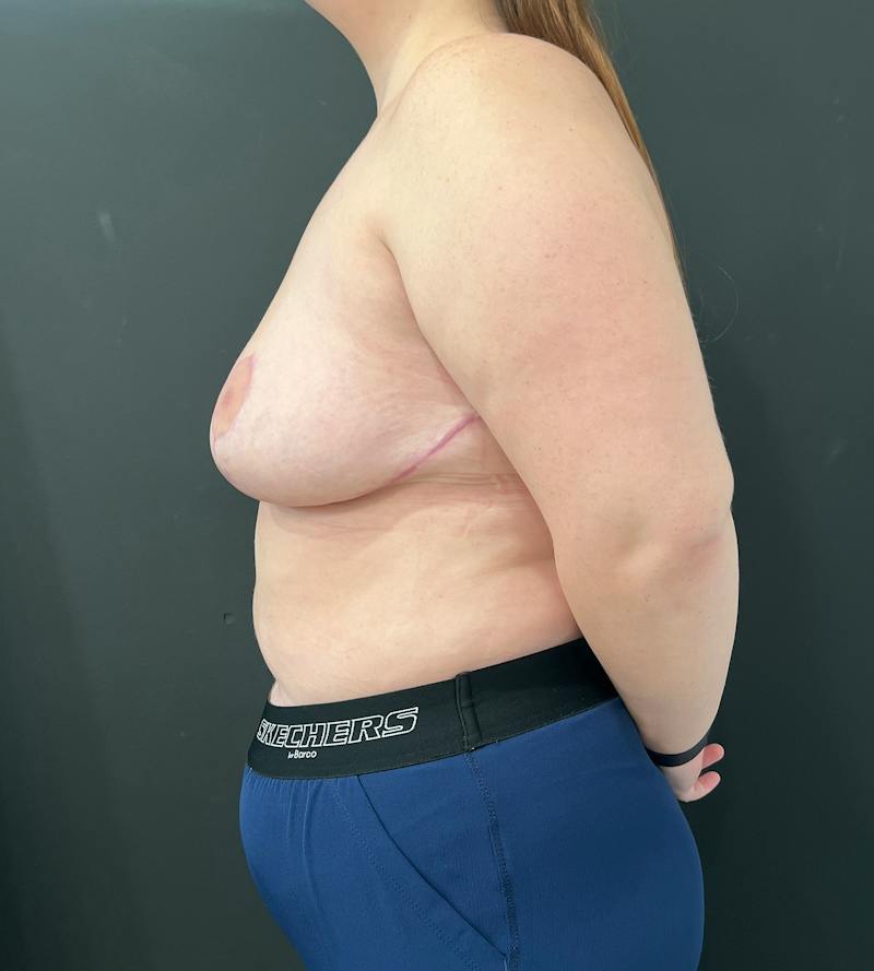 Breast Asymmetry Before & After Gallery - Patient 144861 - Image 10