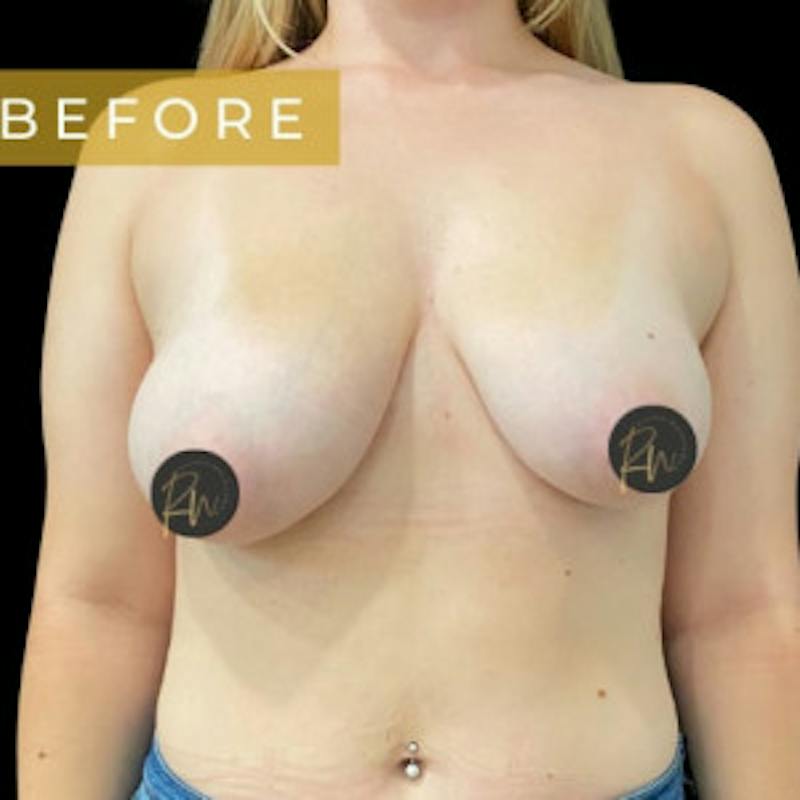 Breast Asymmetry Before & After Gallery - Patient 766144 - Image 1