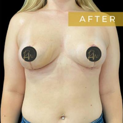 Breast Asymmetry Before & After Gallery - Patient 766144 - Image 2