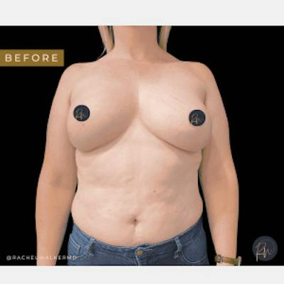 Breast Asymmetry Before & After Gallery - Patient 227240 - Image 1