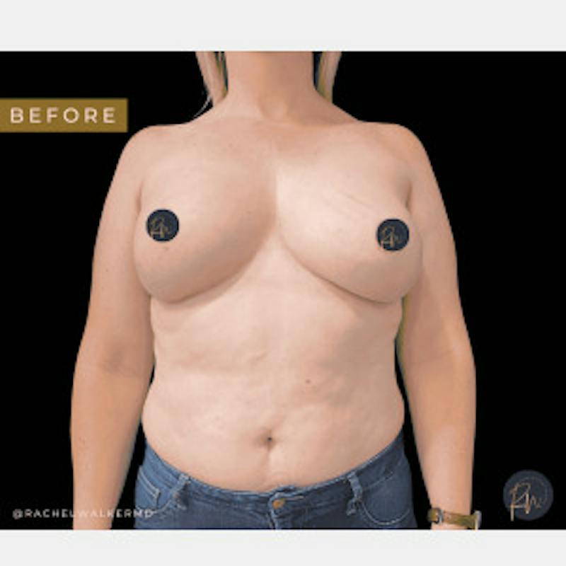 Breast Asymmetry Before & After Gallery - Patient 227240 - Image 1