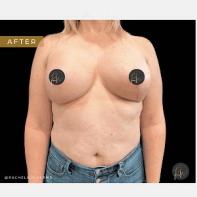 Breast Asymmetry Before & After Gallery - Patient 227240 - Image 2