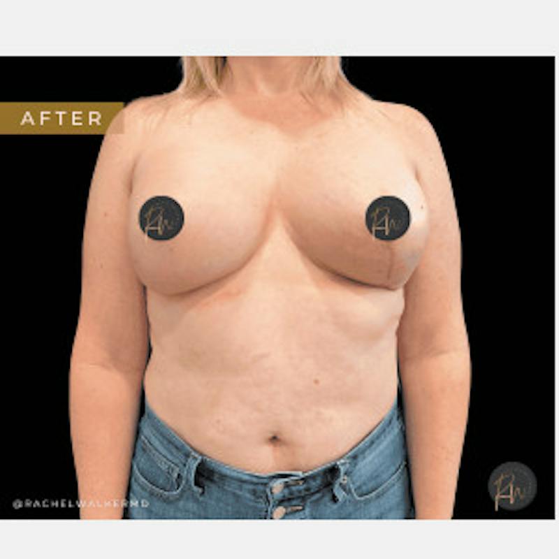 Breast Asymmetry Before & After Gallery - Patient 227240 - Image 2