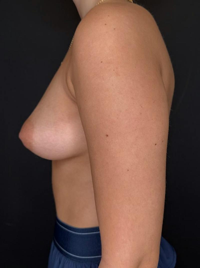 Breast Augmentation Before & After Gallery - Patient 198919 - Image 3