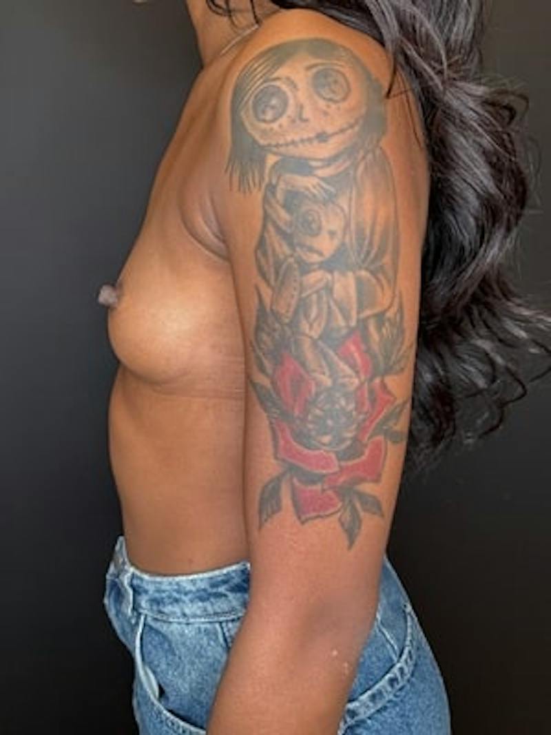 Breast Augmentation Before & After Gallery - Patient 834622 - Image 5
