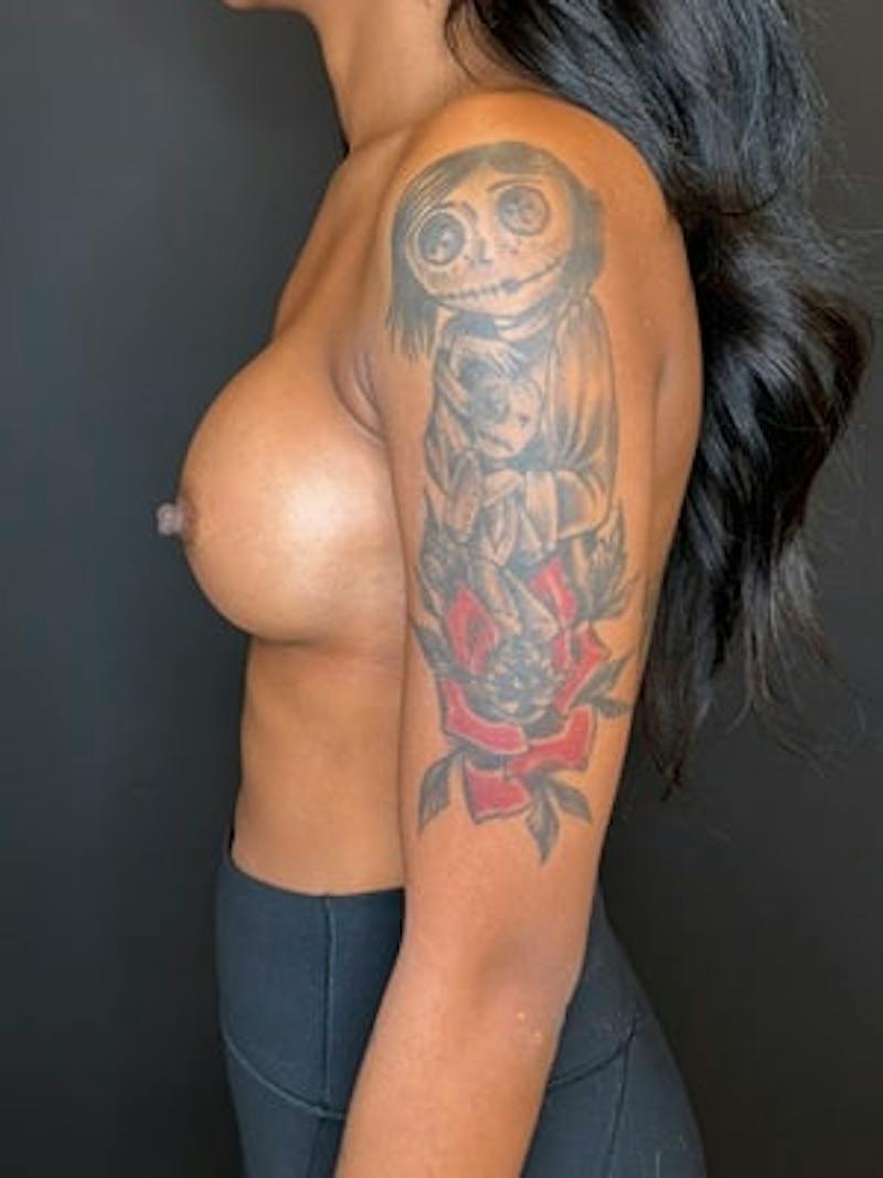 Breast Augmentation Before & After Gallery - Patient 834622 - Image 6