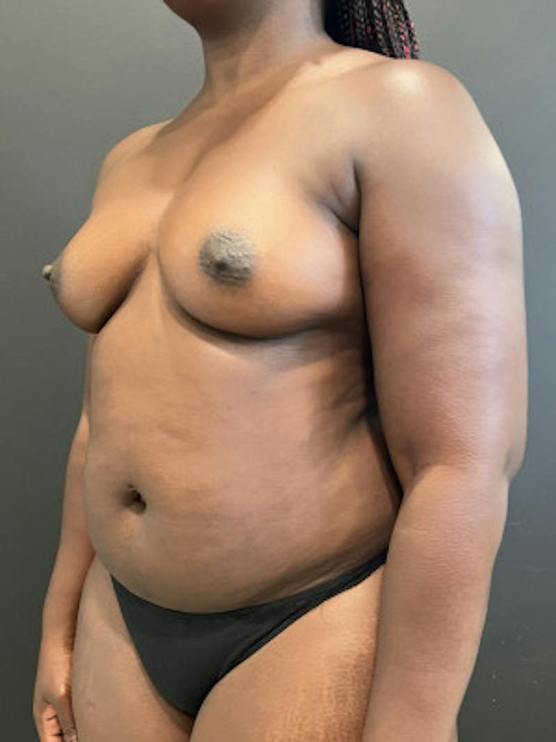 Breast Augmentation Before & After Gallery - Patient 324991 - Image 3