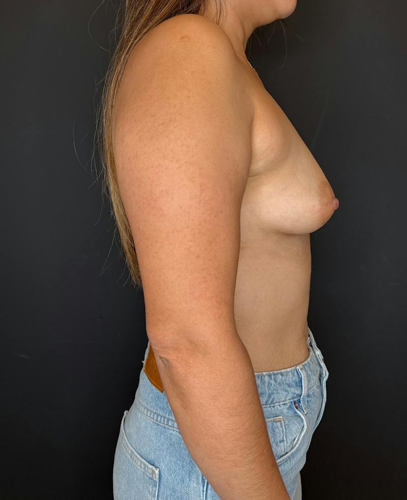 Breast Augmentation Before & After Gallery - Patient 375908 - Image 5