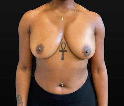 Breast Augmentation Before & After Gallery - Patient 248890 - Image 1