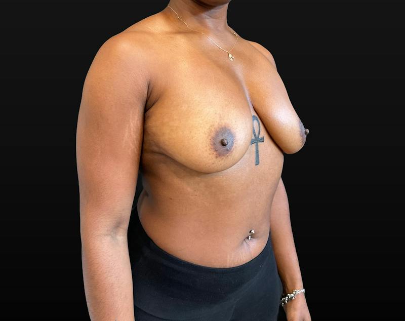 Breast Augmentation Before & After Gallery - Patient 248890 - Image 3