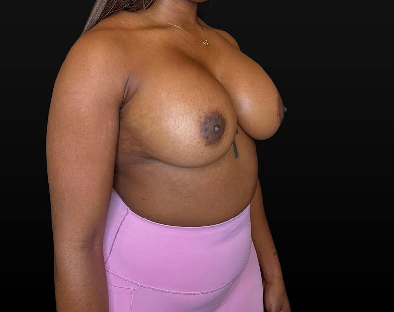 Breast Augmentation Before & After Gallery - Patient 248890 - Image 4