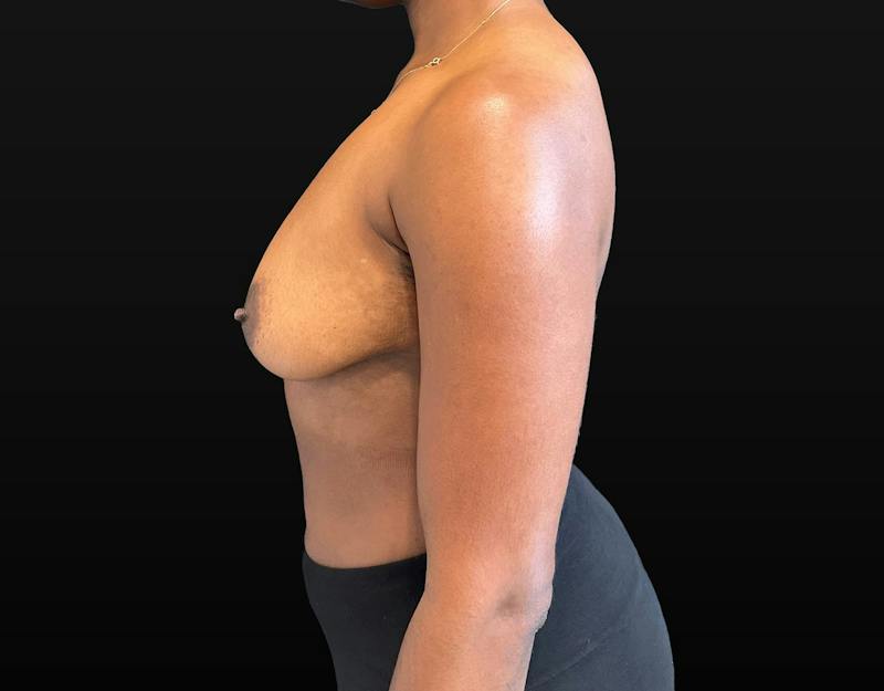 Breast Augmentation Before & After Gallery - Patient 248890 - Image 5