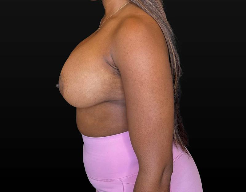 Breast Augmentation Before & After Gallery - Patient 248890 - Image 6