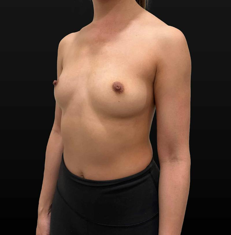 Breast Augmentation Before & After Gallery - Patient 237432 - Image 3