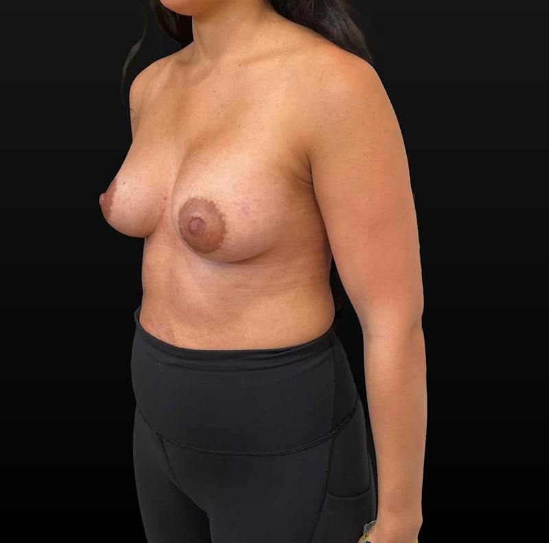 Breast Augmentation Before & After Gallery - Patient 846574 - Image 6