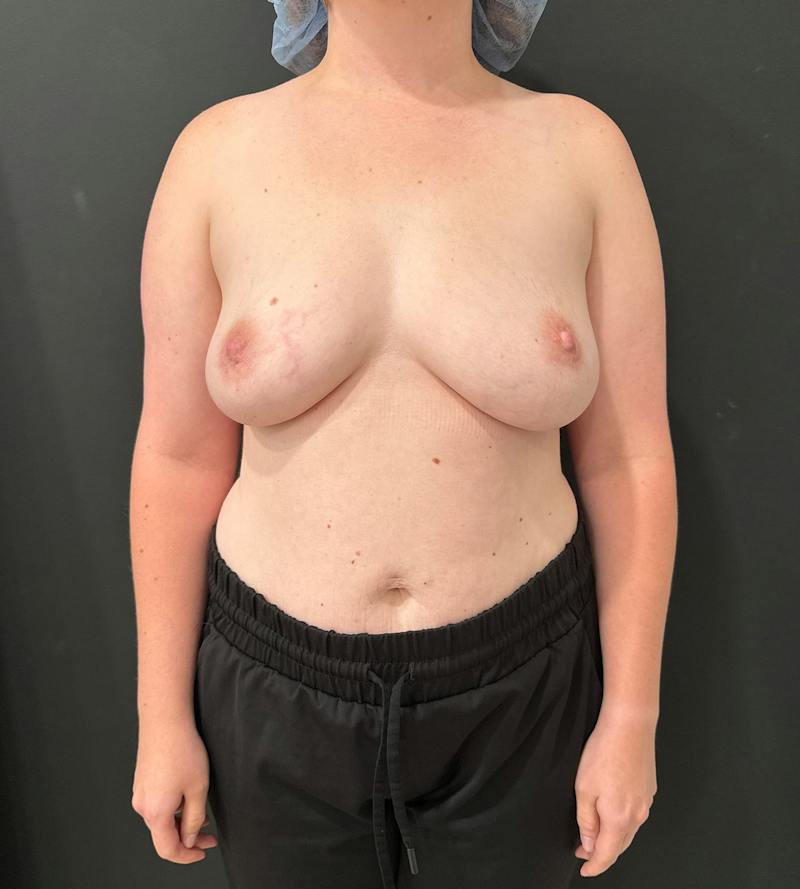 Breast Augmentation Before & After Gallery - Patient 178109 - Image 1