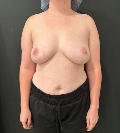 Breast Augmentation Before & After Gallery - Patient 178109 - Image 1