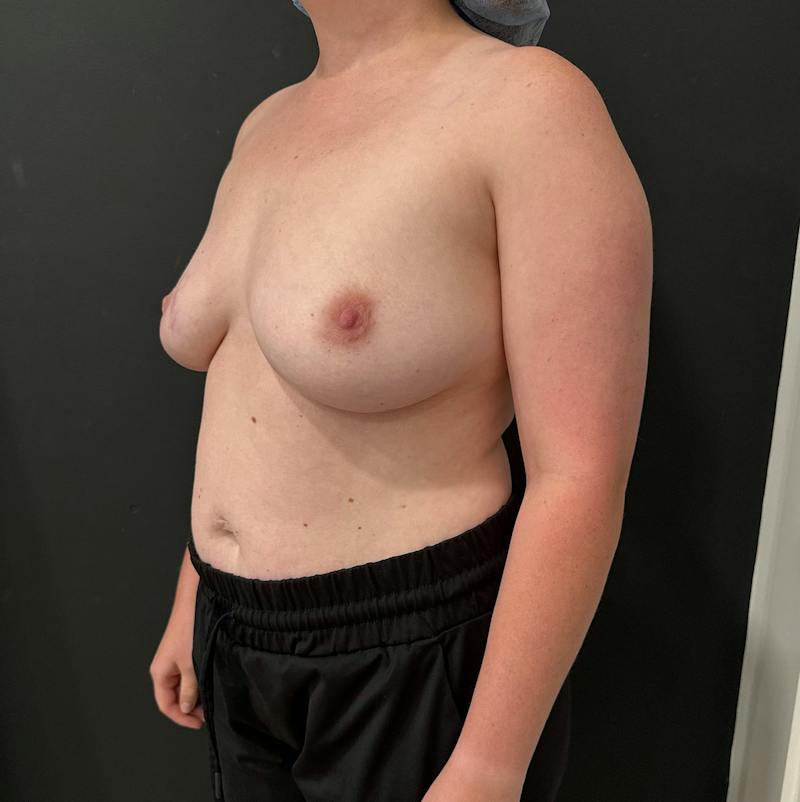 Breast Augmentation Before & After Gallery - Patient 178109 - Image 3