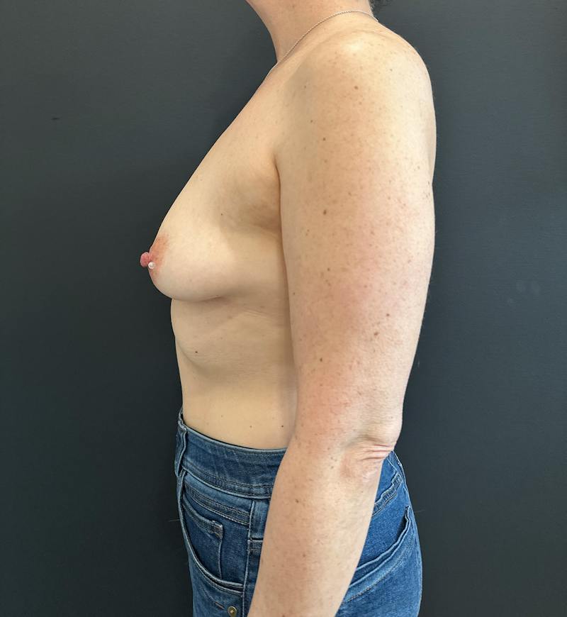 Breast Augmentation Before & After Gallery - Patient 320484 - Image 5