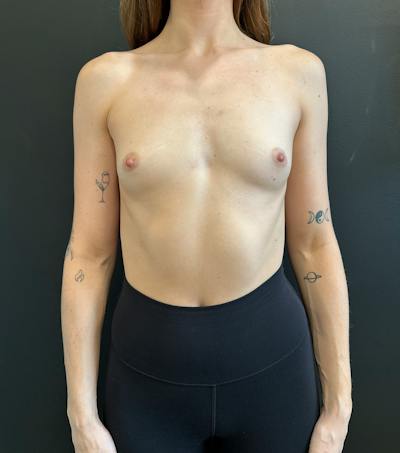 Breast Augmentation Before & After Gallery - Patient 317746 - Image 1