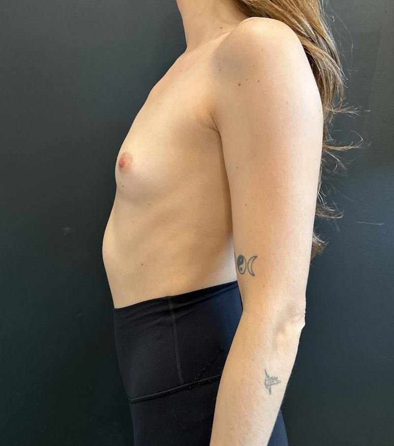 Breast Augmentation Before & After Gallery - Patient 317746 - Image 5