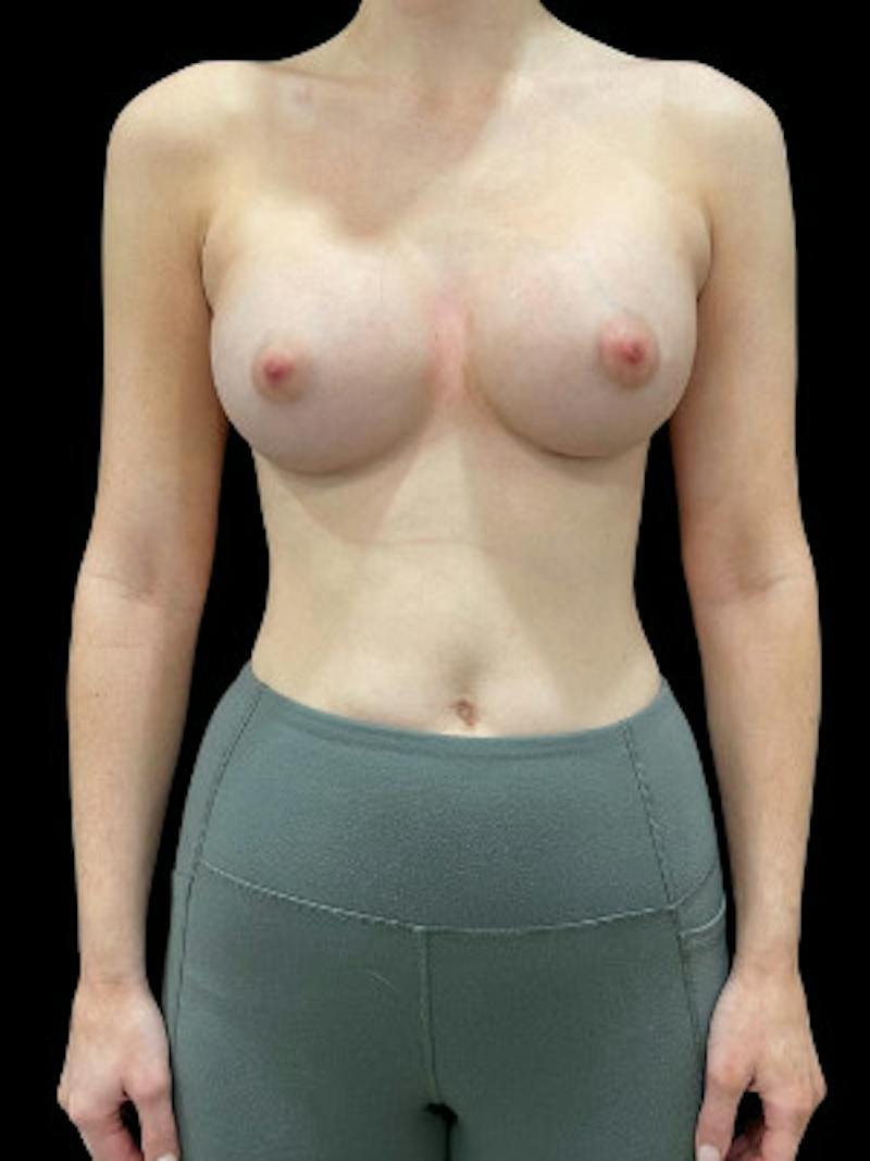 Breast Augmentation Before & After Gallery - Patient 195000 - Image 2