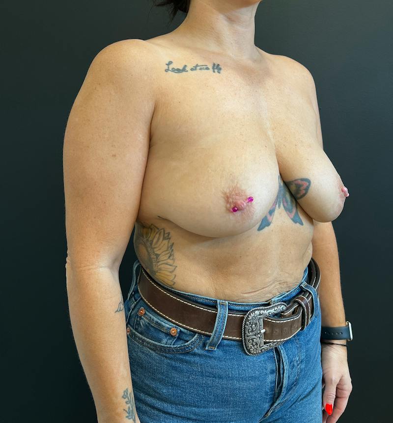 Breast Augmentation Before & After Gallery - Patient 379551 - Image 3