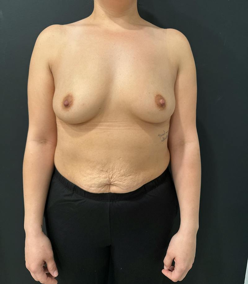 Breast Augmentation Before & After Gallery - Patient 364482 - Image 1