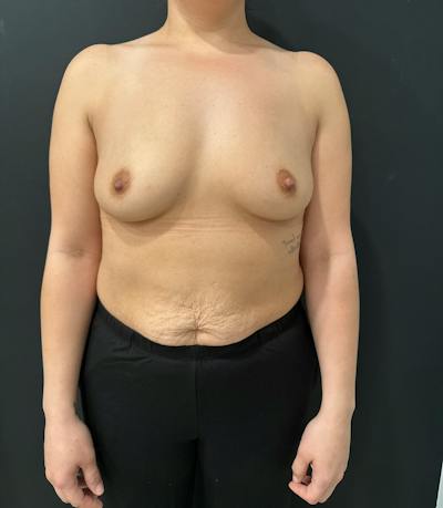 Breast Augmentation Before & After Gallery - Patient 364482 - Image 1