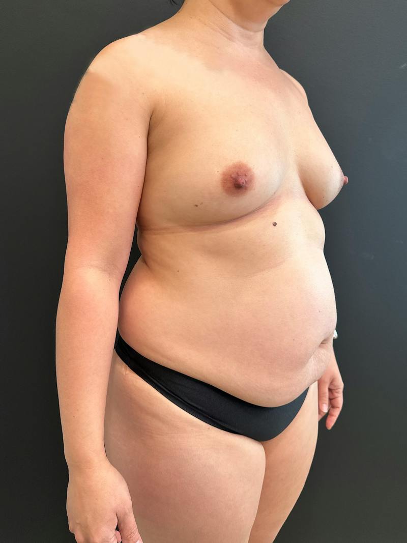SAFElipo Before & After Gallery - Patient 113891 - Image 3