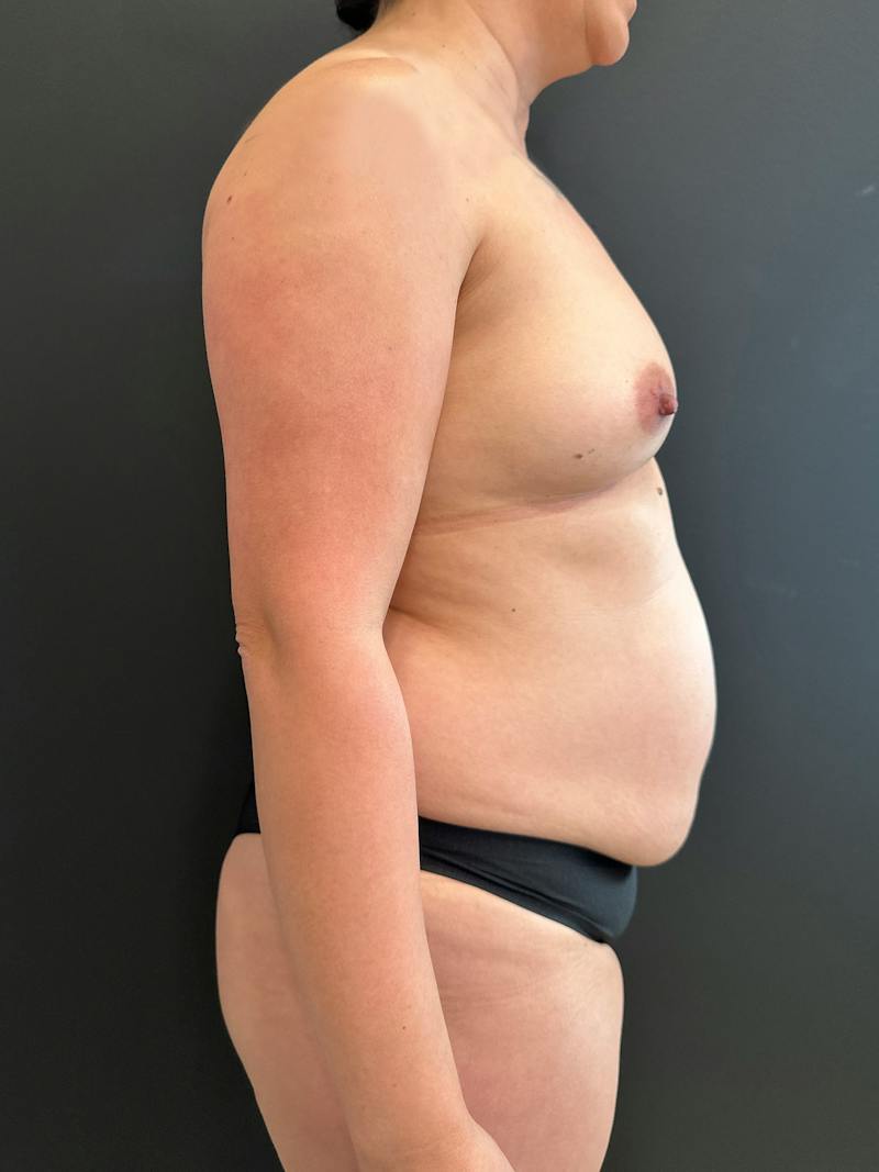 SAFElipo Before & After Gallery - Patient 113891 - Image 5
