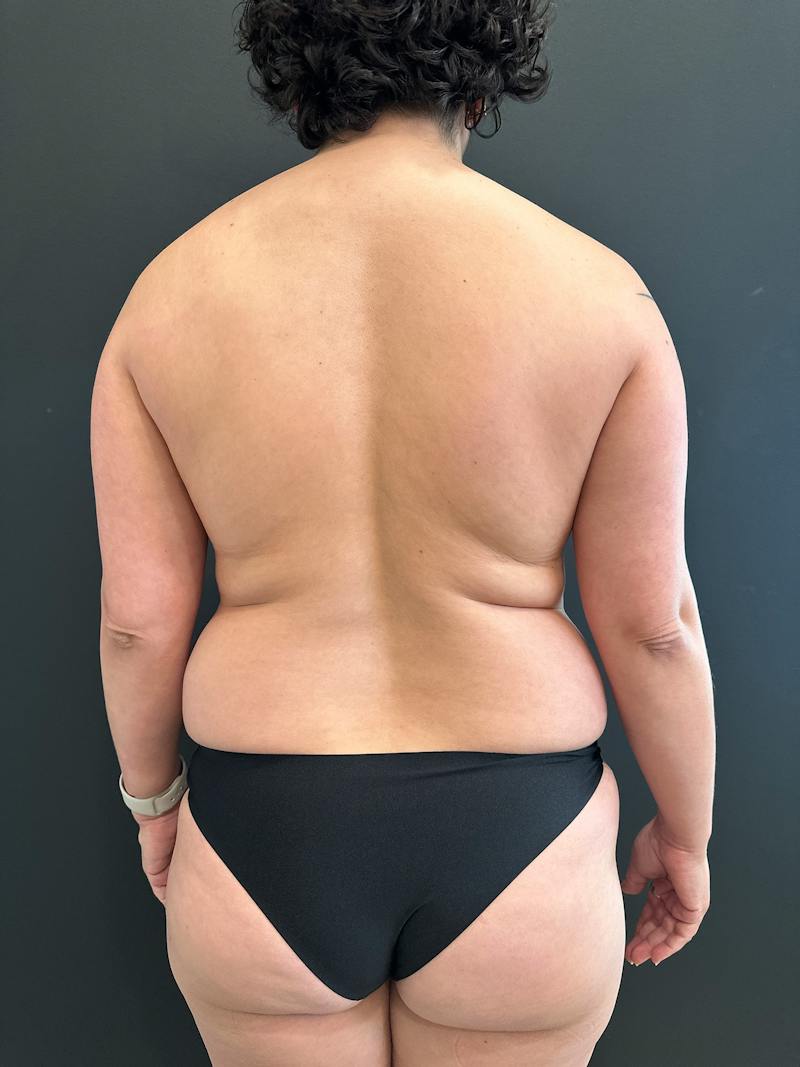 SAFElipo Before & After Gallery - Patient 113891 - Image 7