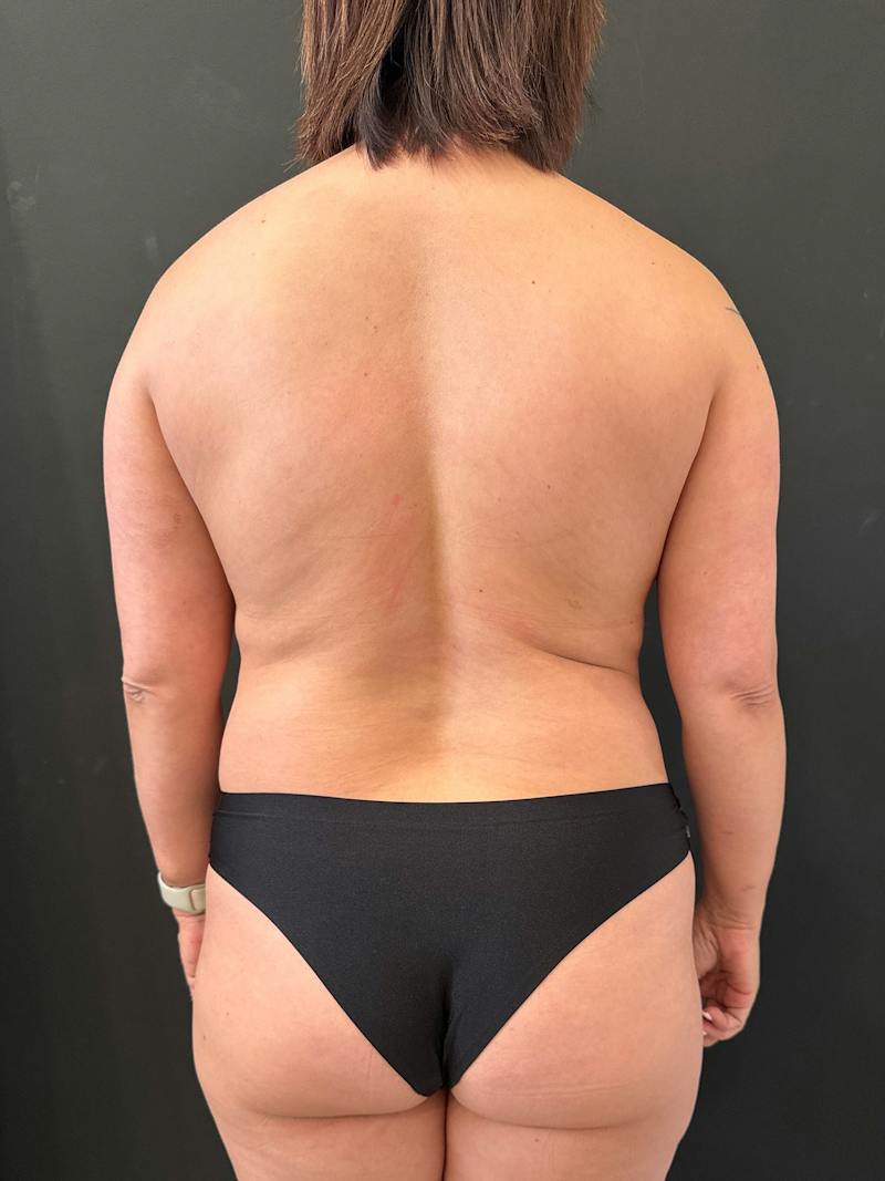 SAFElipo Before & After Gallery - Patient 113891 - Image 8