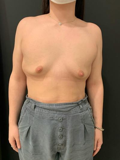 SAFElipo Before & After Gallery - Patient 261532 - Image 1