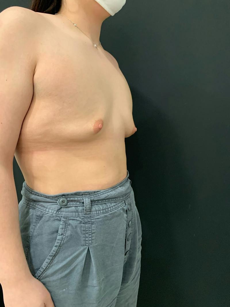 SAFElipo Before & After Gallery - Patient 261532 - Image 3