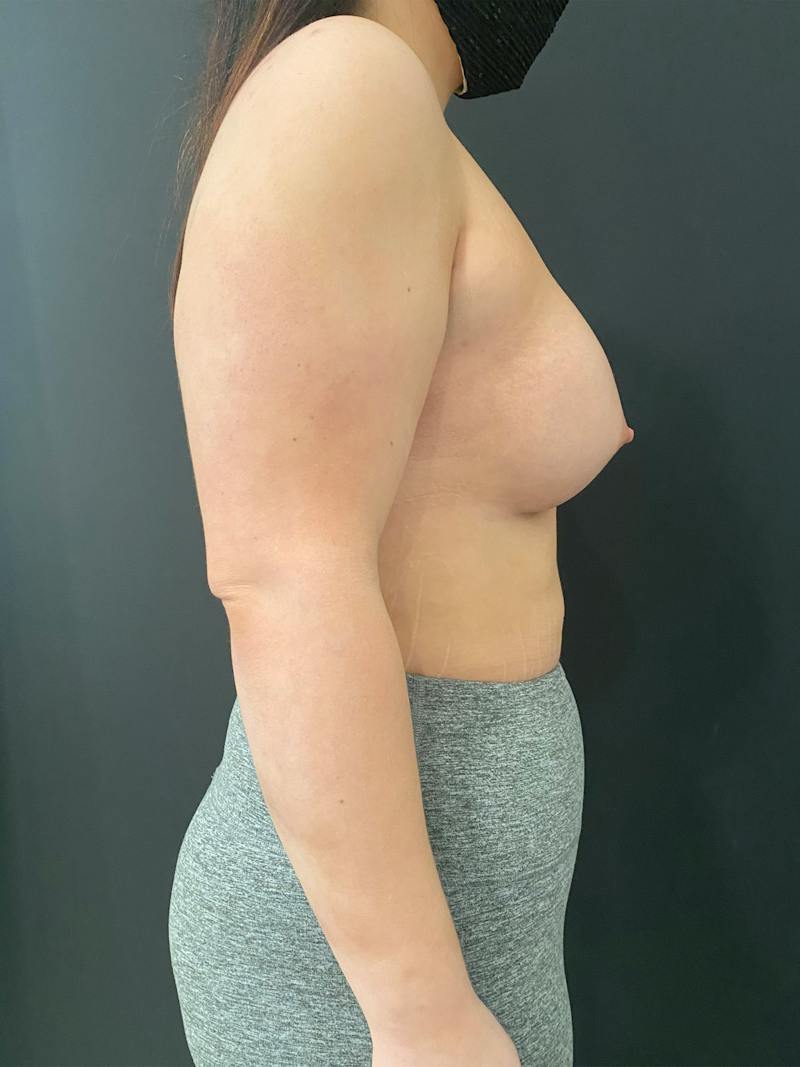 SAFElipo Before & After Gallery - Patient 261532 - Image 6