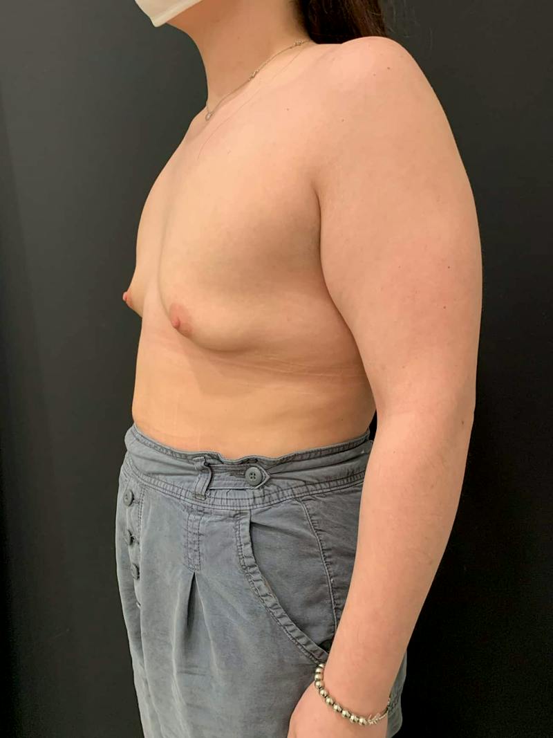 SAFElipo Before & After Gallery - Patient 261532 - Image 7