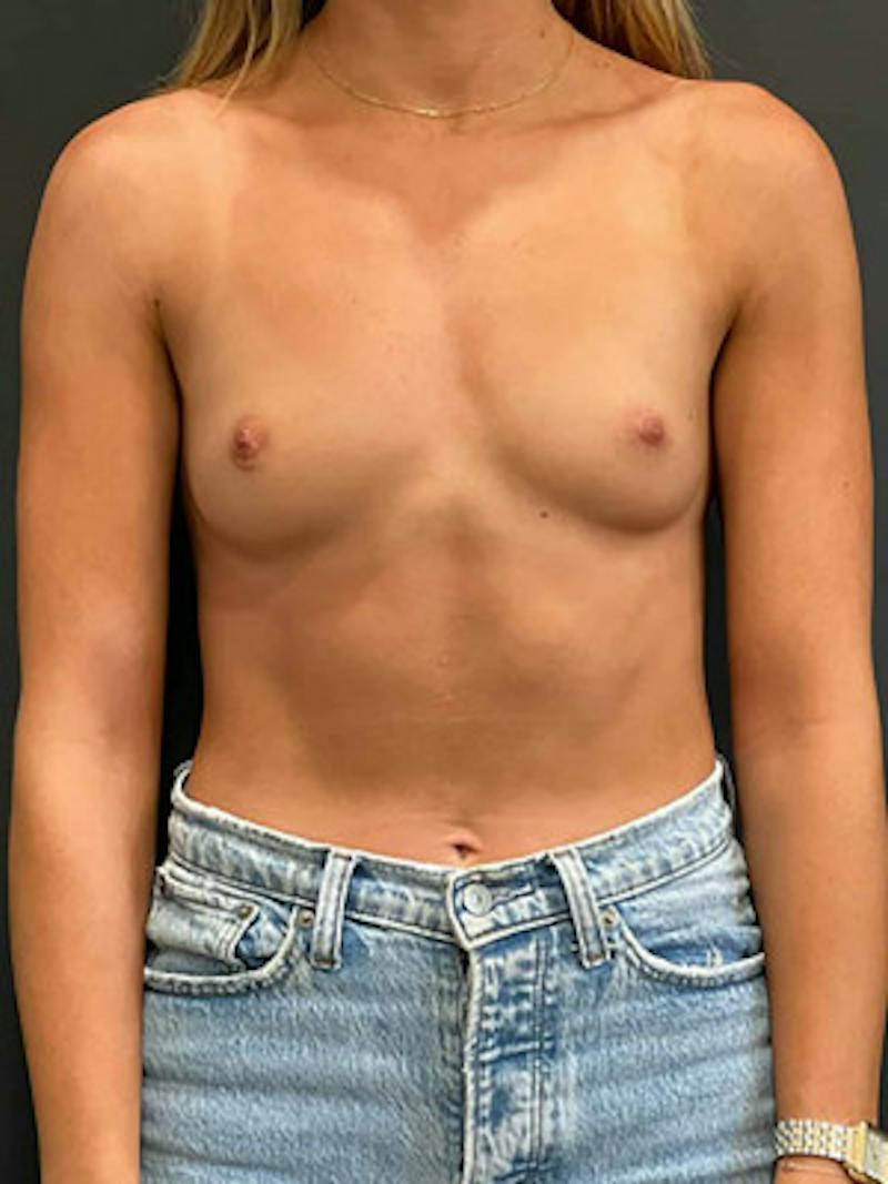 Breast Augmentation Before & After Gallery - Patient 359111 - Image 1