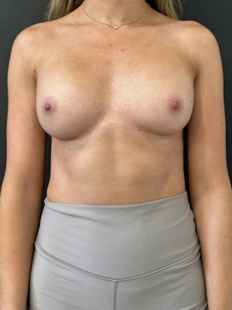 Breast Augmentation Before & After Gallery - Patient 359111 - Image 2
