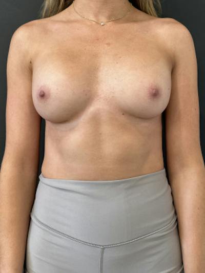Breast Augmentation Before & After Gallery - Patient 359111 - Image 2