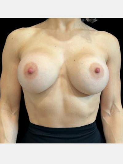 Breast Augmentation Before & After Gallery - Patient 178506 - Image 2