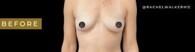 Breast Augmentation Before & After Gallery - Patient 350651 - Image 1