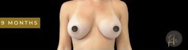 Breast Augmentation Before & After Gallery - Patient 350651 - Image 2