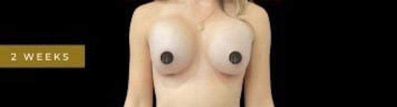 Breast Augmentation Before & After Gallery - Patient 350651 - Image 3