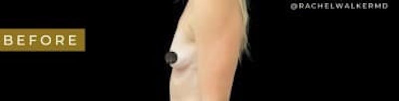 Breast Augmentation Before & After Gallery - Patient 350651 - Image 5