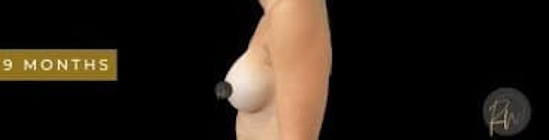 Breast Augmentation Before & After Gallery - Patient 350651 - Image 6