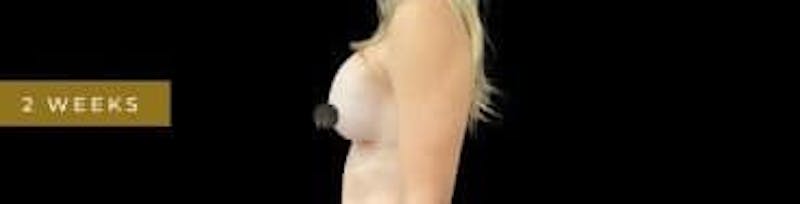Breast Augmentation Before & After Gallery - Patient 350651 - Image 7